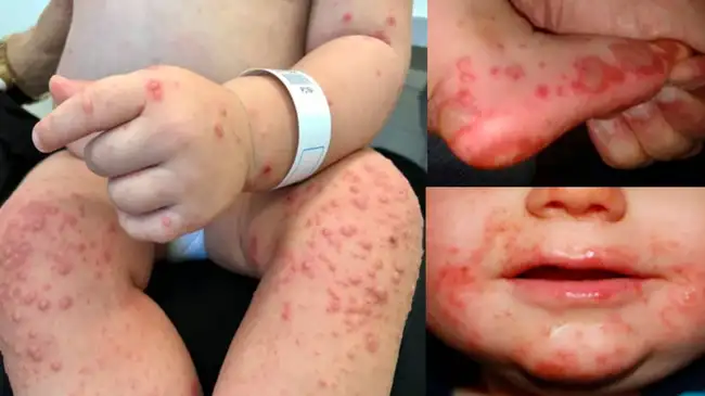 Alerta por virus mano, pie y boca en Perú.  